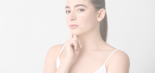 Dealing with Acne-Prone Skin?  Build Your Breakout-Proof Routine