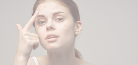 Hormonal Acne vs. Stress Acne: Spot the Difference and Treat Them Right